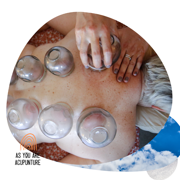 Cupping at 'As You Are Acupuncture'